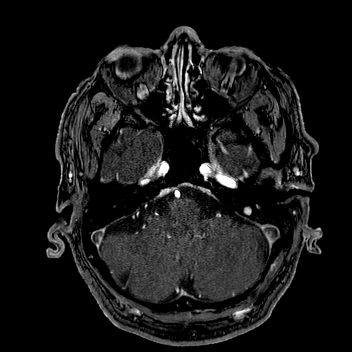 Accessory middle cerebral artery (Radiopaedia 73114-83828 Axial MRA 31).jpg