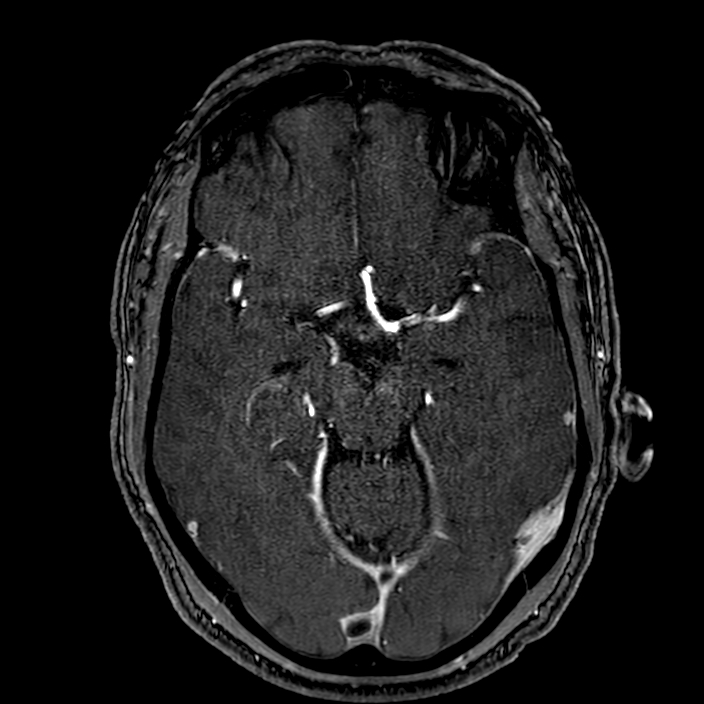 Accessory middle cerebral artery (Radiopaedia 73114-83828 Axial MRA 76).jpg