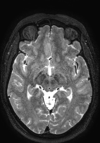 Accessory middle cerebral artery (Radiopaedia 73114-83828 Axial T2 96).jpg