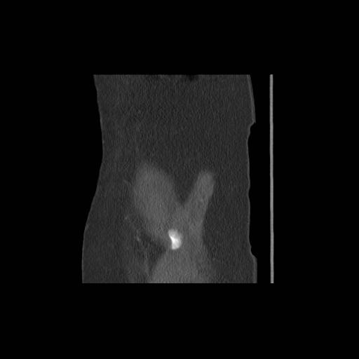 File:Acetabular fracture (Radiopaedia 13193-13212 Sagittal bone window 1).jpg