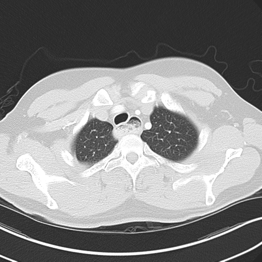 Achalasia of the cardia (Radiopaedia 38497-40595 Axial lung window 10).png