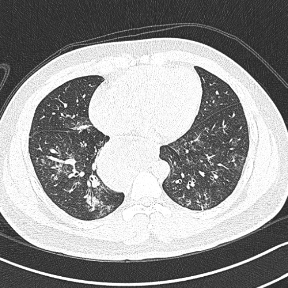 File:Achalasia with aspiration (Radiopaedia 55413-61845 Axial lung window 51).jpg