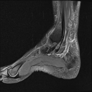 File:Achilles tendon tear (Radiopaedia 77615-89819 Sagittal PD fat sat 5).jpg