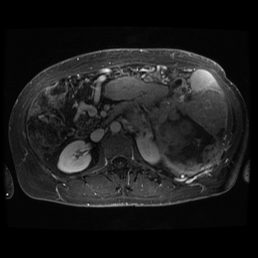 File:Acinar cell carcinoma of the pancreas (Radiopaedia 75442-86668 Axial 286).jpg