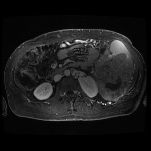 File:Acinar cell carcinoma of the pancreas (Radiopaedia 75442-86668 Axial 300).jpg