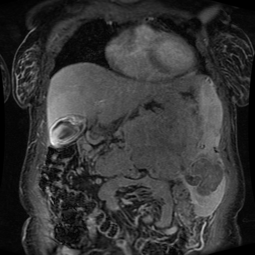 Acinar cell carcinoma of the pancreas (Radiopaedia 75442-86668 Coronal T1 C+ fat sat 134).jpg