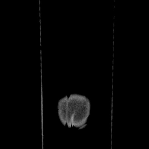 File:Acinar cell carcinoma of the pancreas (Radiopaedia 75442-86669 Coronal C+ portal venous phase 129).jpg