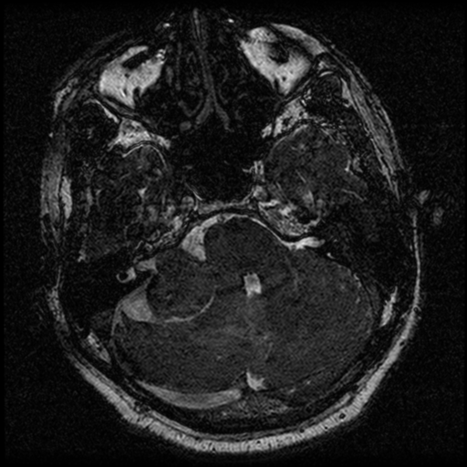 File:Acoustic schwannoma (Radiopaedia 39170-41387 Axial FIESTA 71).png