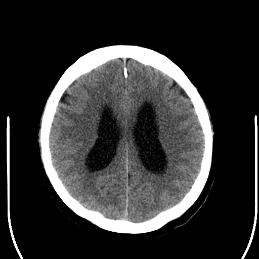 File:Acoustic schwannoma (Radiopaedia 39170-41389 Axial non-contrast 19).png