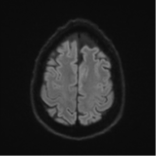 Acoustic schwannoma (Radiopaedia 55729-62281 E 50).png