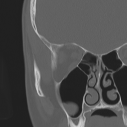 Acoustic schwannoma - eroding petrous apex (Radiopaedia 39674-42002 Coronal bone window 19).png