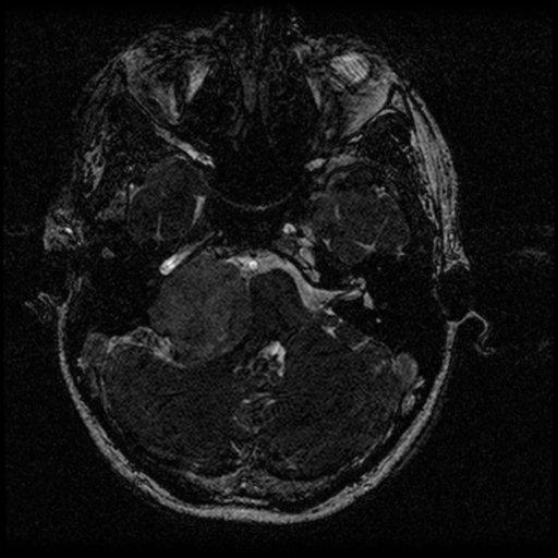 Acoustic schwannoma - eroding petrous apex (Radiopaedia 39674-42004 Axial T2 30).png
