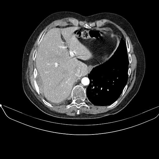 File:Acquired adrenal hyperplasia - due to thymic carcinoid tumor (Radiopaedia 21269-21184 C+ arterial phase 4).jpg