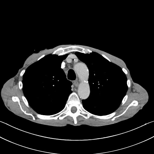 File:Acquired tracheoesophageal fistula (Radiopaedia 57747-65042 Axial C+ portal venous phase 28).jpg
