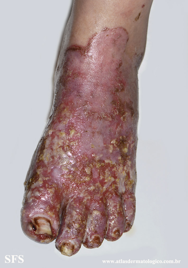 Acrodermatitis Enteropathica (Dermatology Atlas 54).jpg