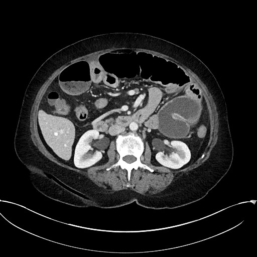 Active Crohn disease (Radiopaedia 59394-66750 Axial C+ portal venous phase 32).jpg