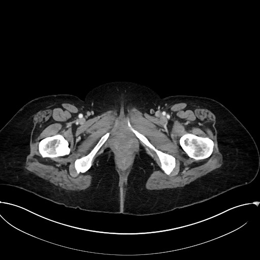Active Crohn disease (Radiopaedia 59394-66750 Axial C+ portal venous phase 75).jpg