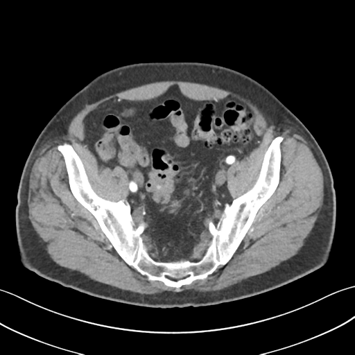 File:Active diverticular hemorrhage (Radiopaedia 39415-41725 Axial C+ arterial phase 55).png