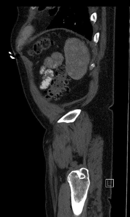 Active lower gastrointestinal bleeding - diverticular (Radiopaedia 61203-69106 Sagittal C+ arterial phase 16).jpg