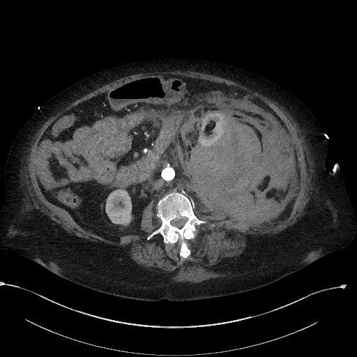 File:Active renal extravasation with large subcapsular and retroperitoneal hemorrhage (Radiopaedia 60975-68796 Axial 35).jpg