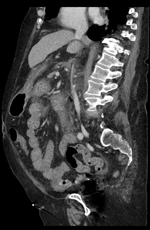 Active renal extravasation with large subcapsular and retroperitoneal hemorrhage (Radiopaedia 60975-68796 Sagittal C+ portal venous phase 129).jpg