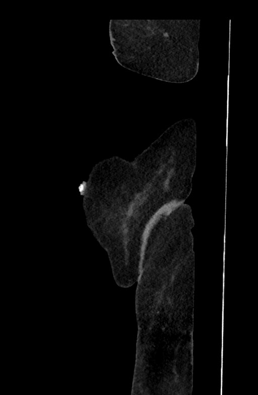Active renal extravasation with large subcapsular and retroperitoneal hemorrhage (Radiopaedia 60975-68796 Sagittal C+ portal venous phase 219).jpg
