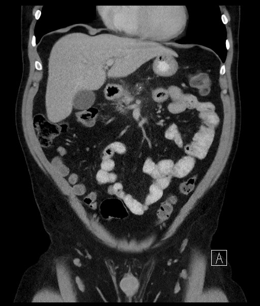 Acute-on-chronic pancreatitis (Radiopaedia 67286-76656 Coronal C+ portal venous phase 31).jpg
