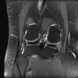 File:Acute-on-chronic transient lateral patellar dislocation with trochlear dysplasia (Radiopaedia 84099-99349 Coronal PD fat sat 14).jpg