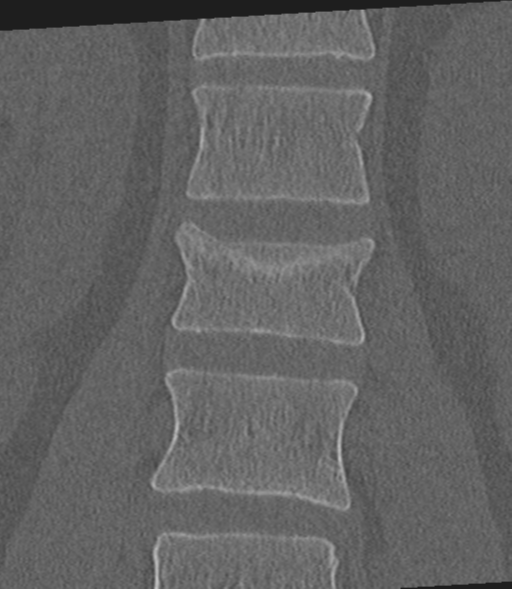 Acute L1 burst compression fracture (Radiopaedia 34430-35755 Coronal bone window 26).png