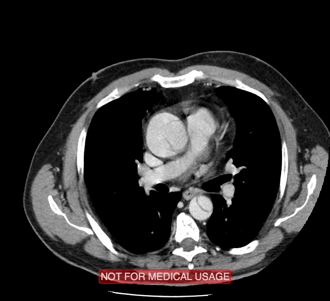 Acute aortic dissection - Stanford type A (Radiopaedia 40661-43285 Axial C+ portal venous phase 23).jpg