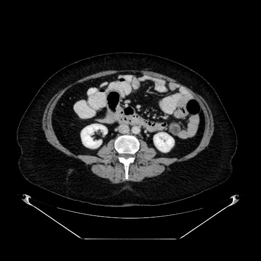Acute appendicitis, heterotaxy syndrome (Radiopaedia 66884-76202 Axial C+ portal venous phase 66).jpg