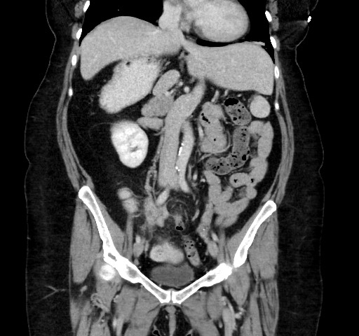Acute appendicitis, heterotaxy syndrome (Radiopaedia 66884-76202 Coronal C+ portal venous phase 59).jpg