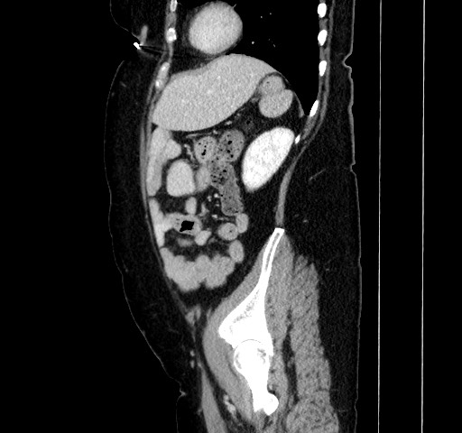 Acute appendicitis, heterotaxy syndrome (Radiopaedia 66884-76202 Sagittal C+ portal venous phase 100).jpg