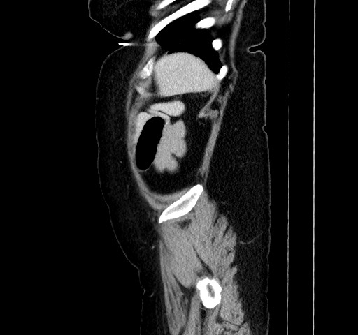 Acute appendicitis, heterotaxy syndrome (Radiopaedia 66884-76202 Sagittal C+ portal venous phase 113).jpg