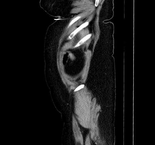 File:Acute appendicitis, heterotaxy syndrome (Radiopaedia 66884-76202 Sagittal C+ portal venous phase 117).jpg