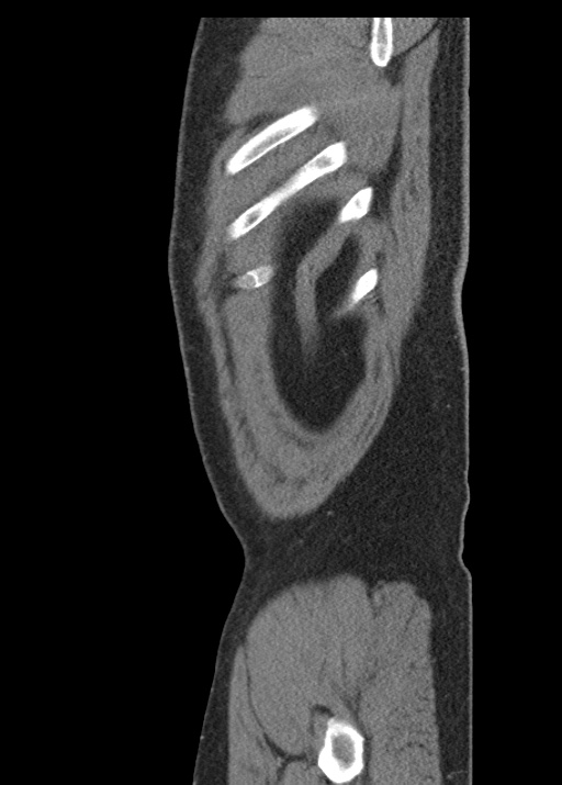 Acute appendicitis (Radiopaedia 48511-53463 Sagittal C+ portal venous phase 121).jpg