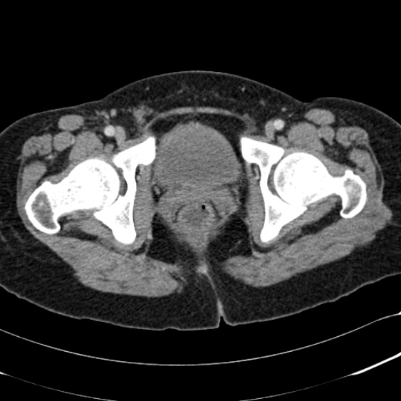 Acute appendicitis (Radiopaedia 48792-53822 Axial C+ portal venous phase 116).jpg