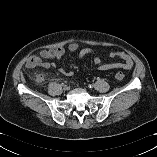 Acute appendicitis (Radiopaedia 58627-65818 Axial non-contrast 63).jpg