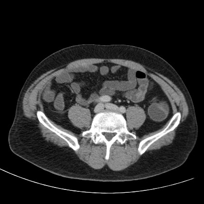 Acute appendicitis (Radiopaedia 66513-75790 Axial C+ portal venous phase 57).jpg