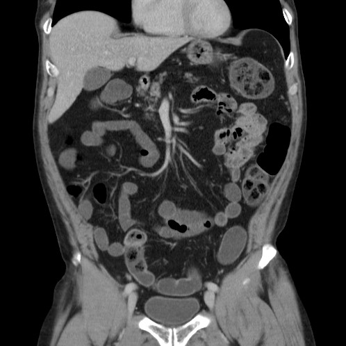 Acute appendicitis (Radiopaedia 66513-75790 Coronal C+ portal venous phase 23).jpg