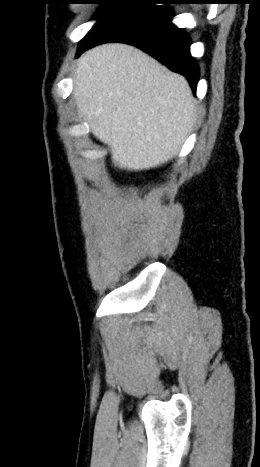 Acute appendicitis (Radiopaedia 77016-88960 Sagittal C+ portal venous phase 100).jpg