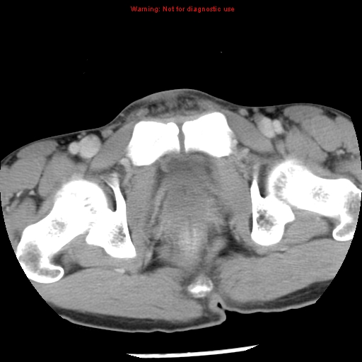 Acute appendicitis (Radiopaedia 8195-9045 Axial C+ portal venous phase 76).jpg