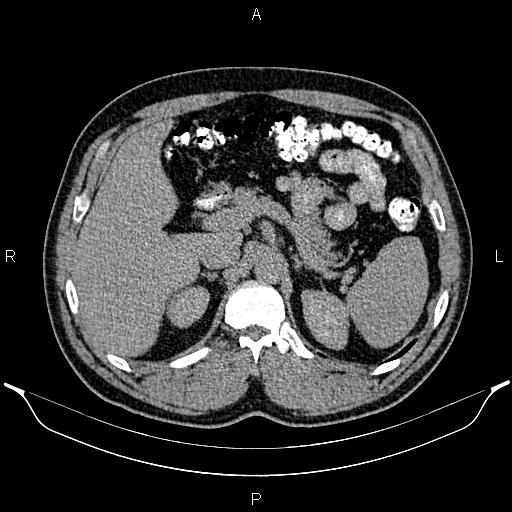 File:Acute appendicitis (Radiopaedia 84780-100240 Axial C+ delayed 29).jpg