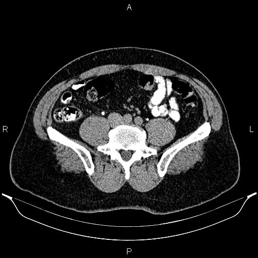 File:Acute appendicitis (Radiopaedia 84780-100240 Axial C+ delayed 71).jpg