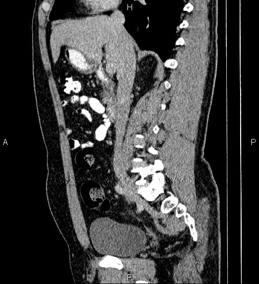 Acute appendicitis (Radiopaedia 84780-100240 Sagittal C+ portal venous phase 43).jpg