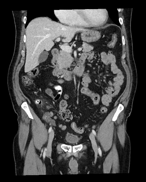 Acute appendicitis - large appendicoliths (Radiopaedia 61805-69820 Coronal C+ portal venous phase 56).jpg