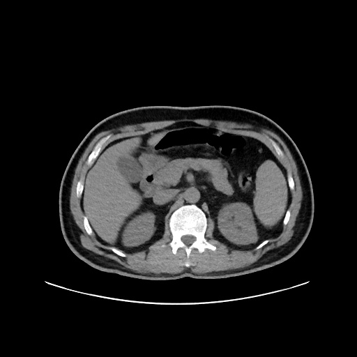 Acute appendicitis and COVID 19 pneumonia (Radiopaedia 76604-88380 Axial non-contrast 63).jpg