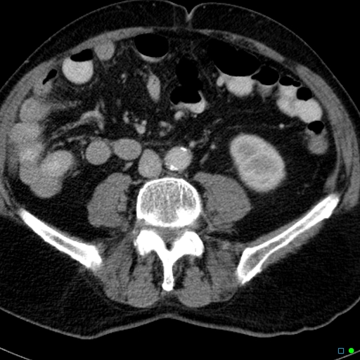 File:Acute appendicitis arising from a malrotated cecum (Radiopaedia 19970-19997 Axial C+ portal venous phase 21).jpg