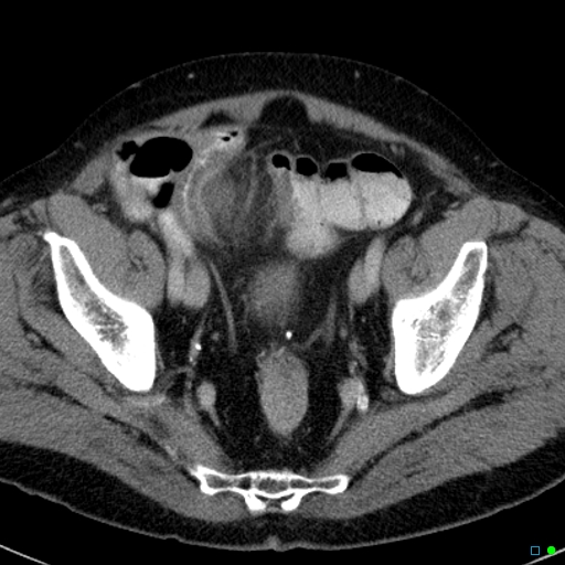 File:Acute appendicitis arising from a malrotated cecum (Radiopaedia 19970-19997 Axial C+ portal venous phase 41).jpg