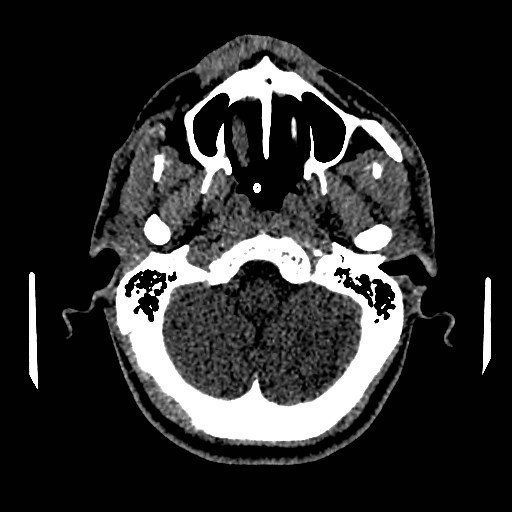 File:Acute basilar artery occlusion (Radiopaedia 43582-46985 Axial non-contrast 40).jpg